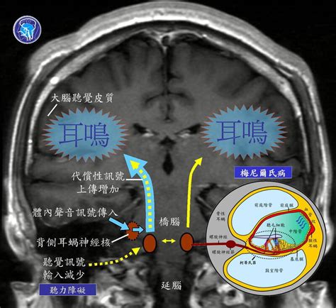 腦嗚的原因|健康網》耳鳴、腦鳴傻傻分不清 醫教辨別細節